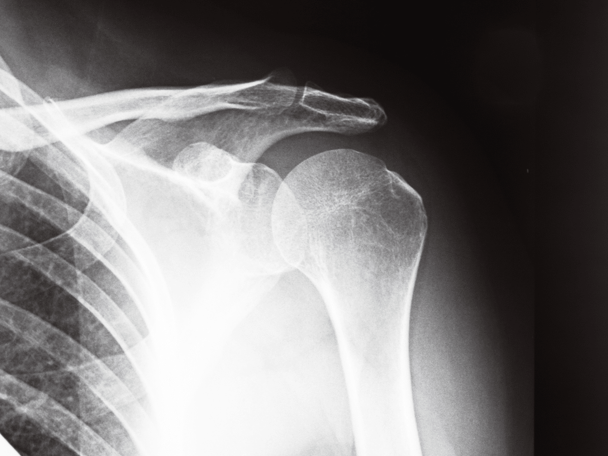 An X-ray of a shoulder fracture.